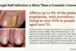 Clinical Efficacy and Management of Onychomycosis Treatments