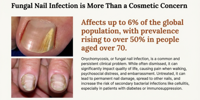 Clinical Efficacy and Management of Onychomycosis Treatments
