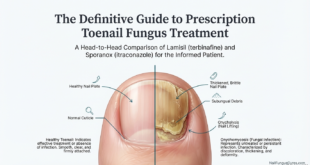 Guide: Lamisil vs Sporanox: A Guide to Severe Nail Fungus Cures